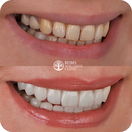 Why Choose Dental Veneers